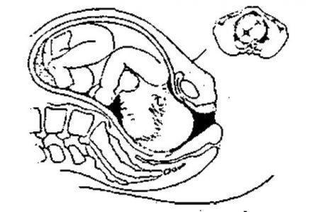 2. Теперь раскрытие полное. Головка и тело ребёнка начинают разворачиваться, когда головка проталкивается через родовой канал. Головка поворачивается, когда она встречает сопротивление дна матки.