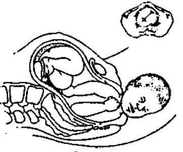 5. Головка родилась, и начинает вращаться тело. Когда вращение закончится, затылок будет повёрнут к левому бедру матери.