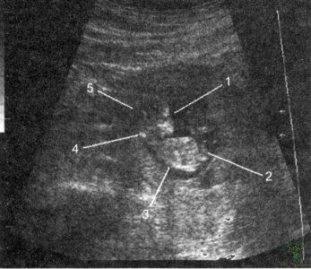 Рис. 21. Эхограмма. Эмбрион в 11 нед беременности. 1 — лицо эмбриона; 2 — конечности эмбриона; 3 — позвоночник эмбриона; 4 — воротниковое пространство эмбриона; 5 — головка эмбриона.