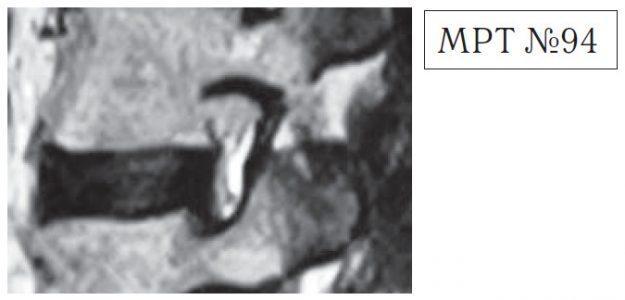 На МРТ №94 наблюдается позвоночно-двигательный сегмент в стадии развития дегенерации.