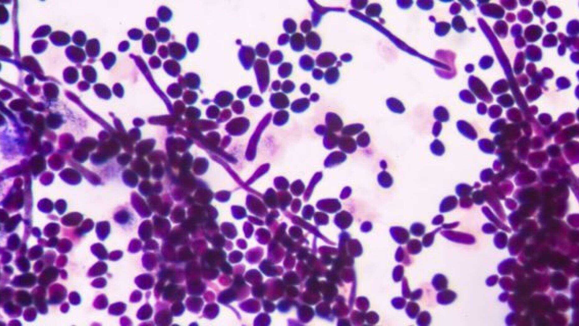 Молочница вылечена - раз и навсегда!