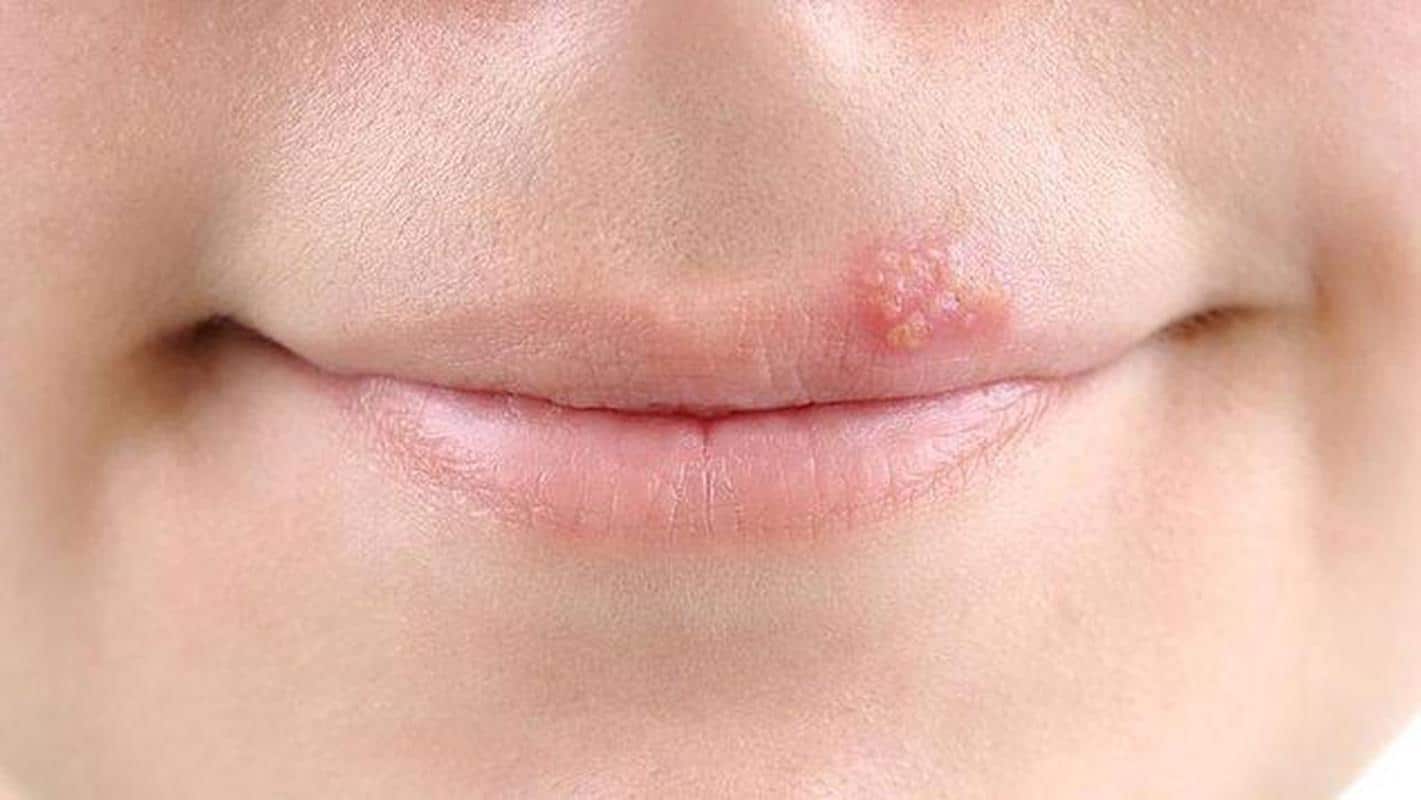 Почему на губах появляется простуда и как ее вылечить